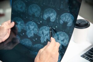 Person pointing a pen at MRI brain scan images while reviewing a traumatic brain injury case